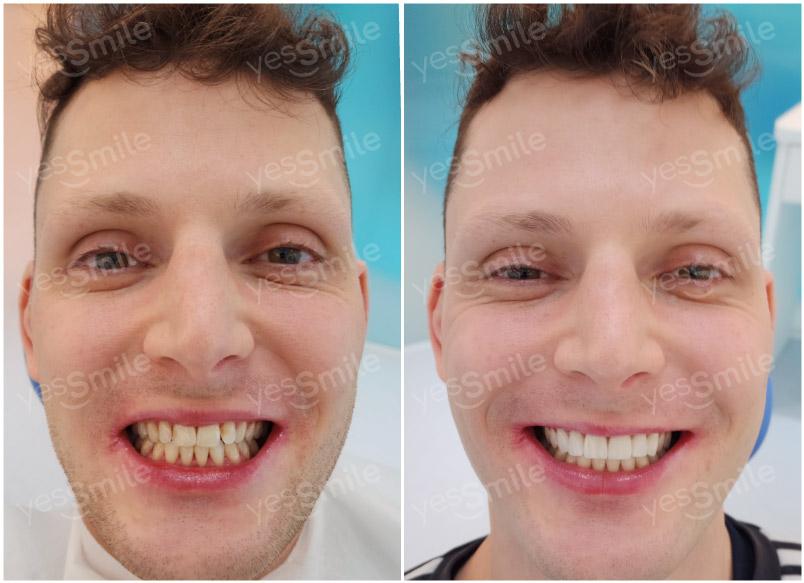 32,Zirkonuim Kronen,Veneers,Implantate